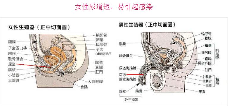 女性为何容易尿道感染?
