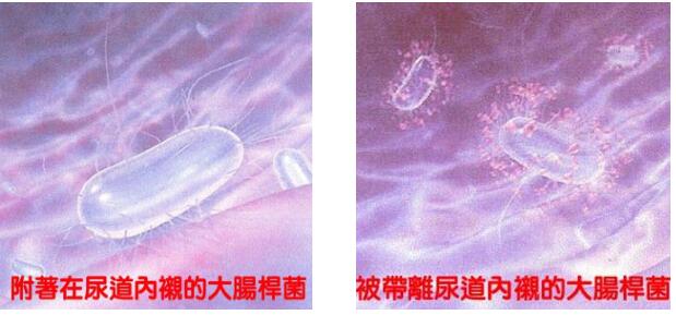 泌尿道感染 预防重于治疗