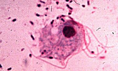 滴虫性外阴炎为什么要复诊