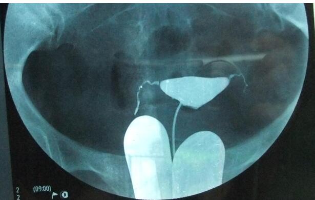 子宫输卵管造影